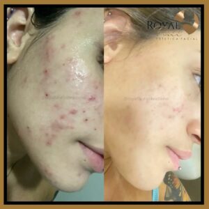 Antes e depois de uma paciente que realizou microagulhamento na Royal Face.