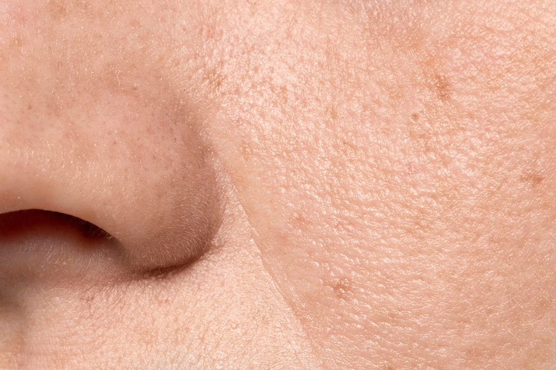 Minimização dos poros dilatados