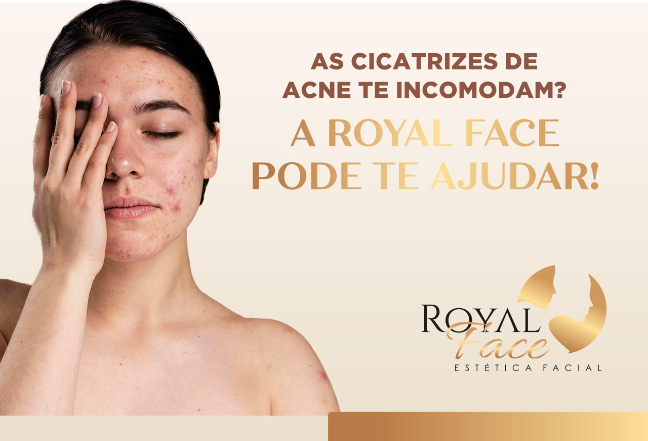 As cicatrizes de acne te incomodam? A Royal Face pode te ajudar!