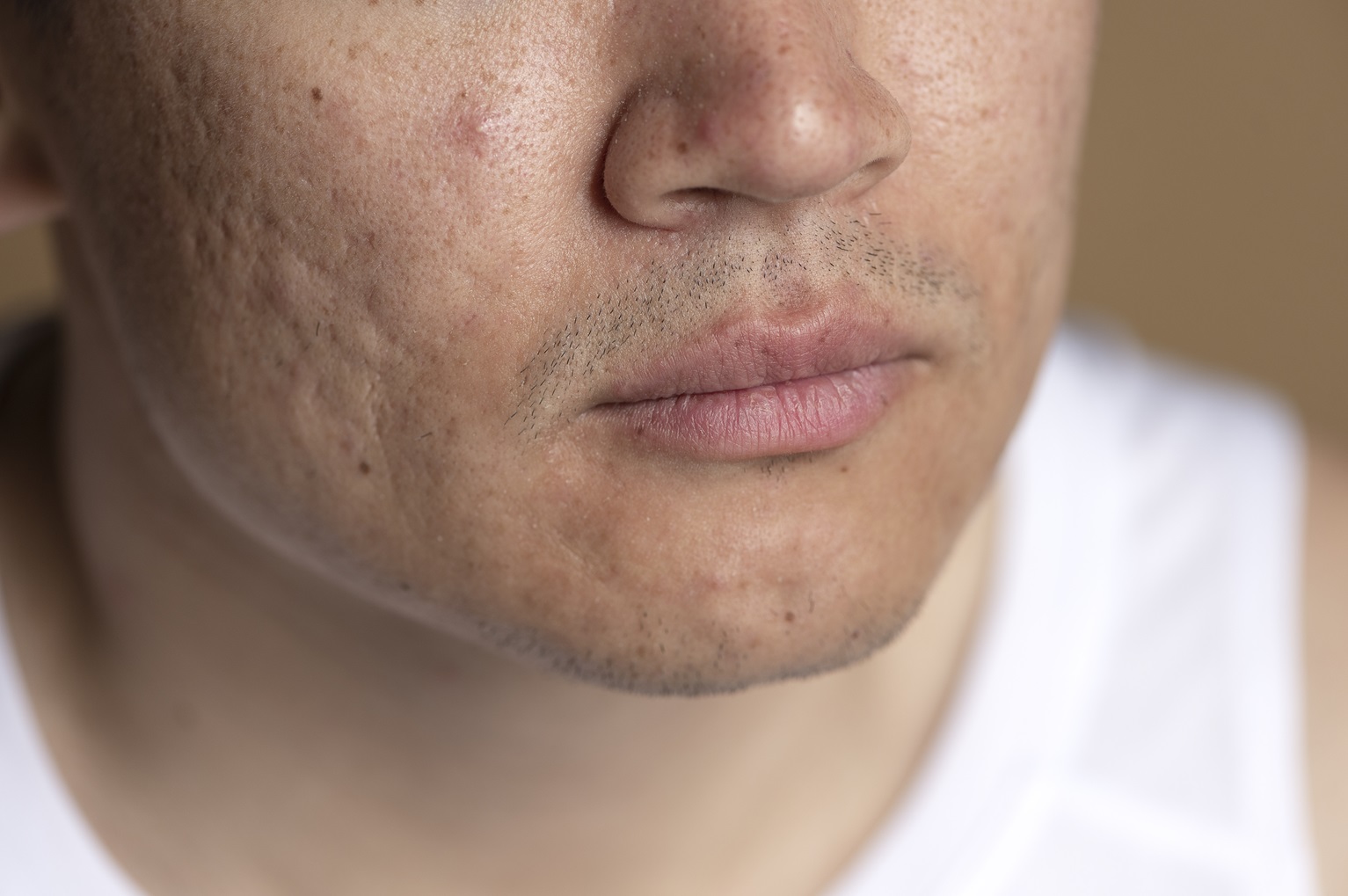 O impacto das cicatrizes de acne